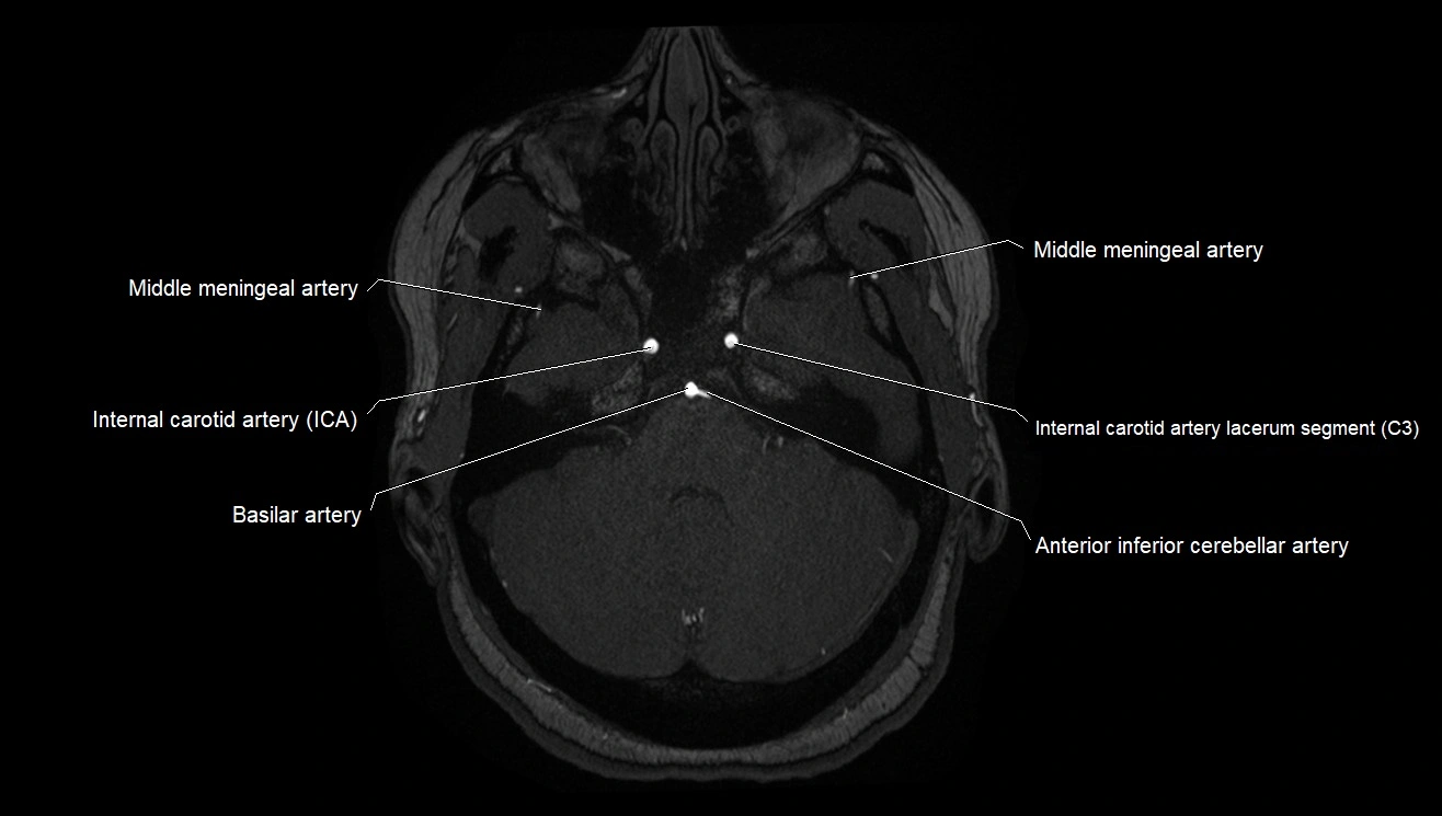 MRA brain (cerebral arteries) anatomy axial 3T image 4.webp